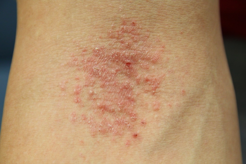 eczema