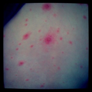 chicken pox